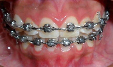 Brackets de Autoligado