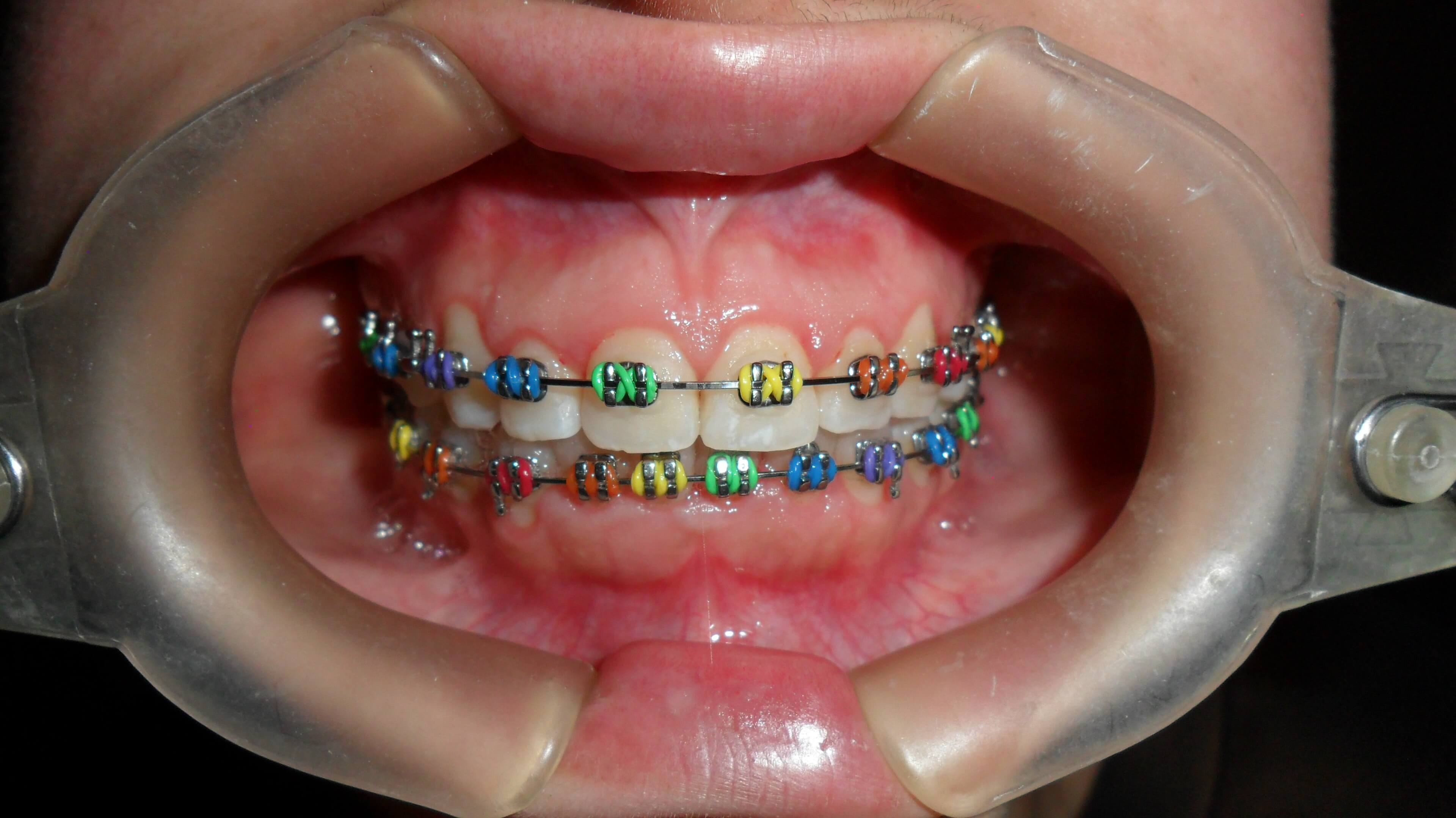 Brackets Metálicos