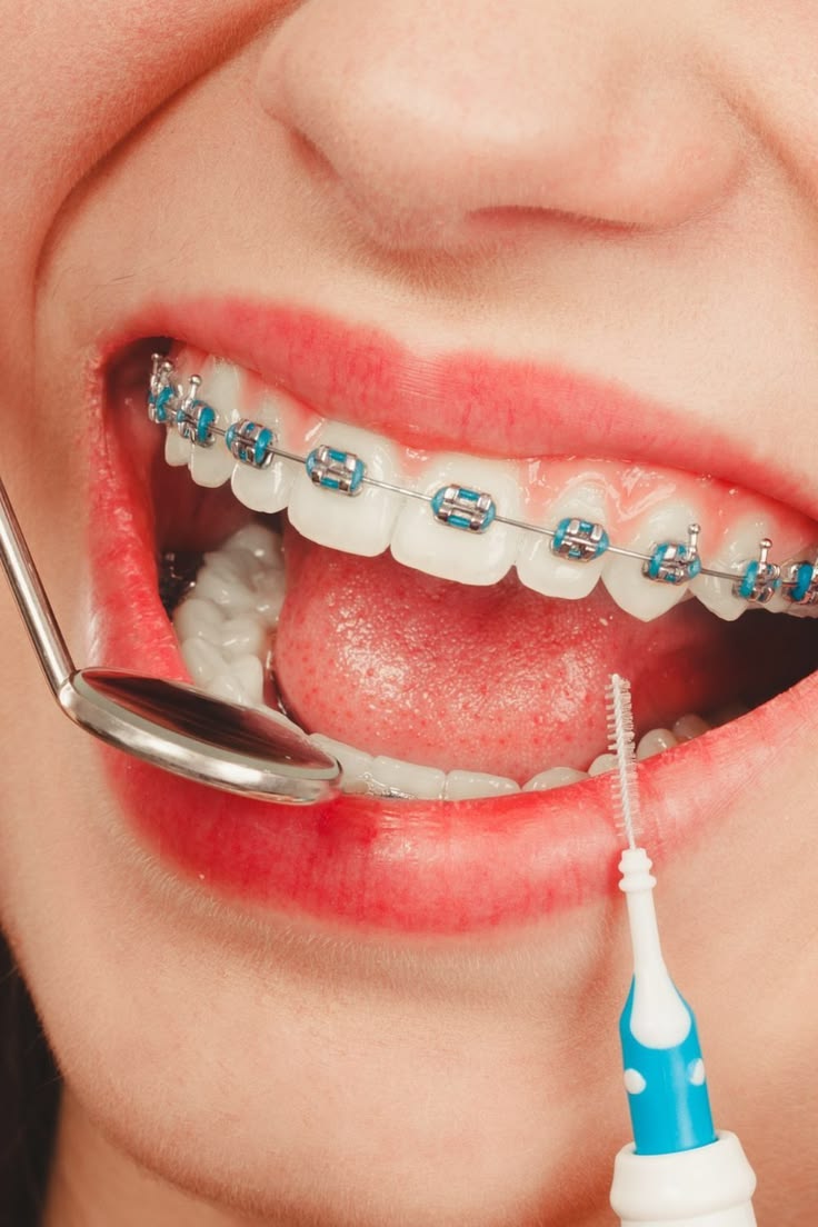 Técnicas de Cepillado con Brackets | Guía Completa